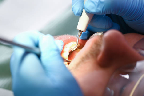 Best Emergency Tooth Extraction in Greenville, NC